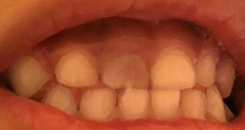 子どもが前歯をぶつけて変色 神経や永久歯への影響は かつかつ主夫ブログ