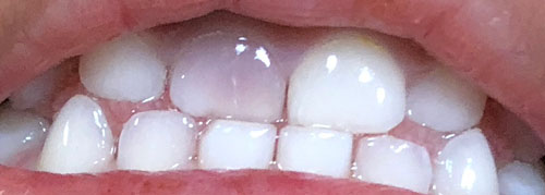 子どもが前歯をぶつけて変色 神経や永久歯への影響は かつかつ主夫ブログ